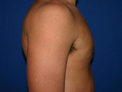 Gynecomastia Before & After Image