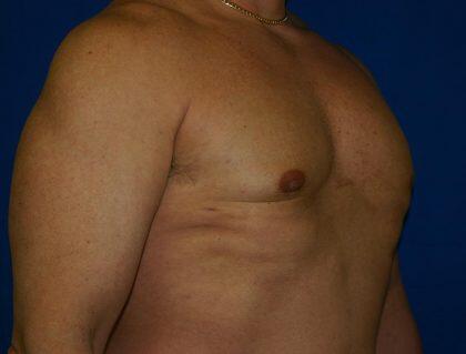 Gynecomastia Before & After Image