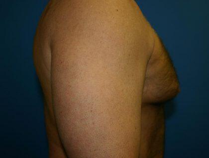 Gynecomastia Before & After Image