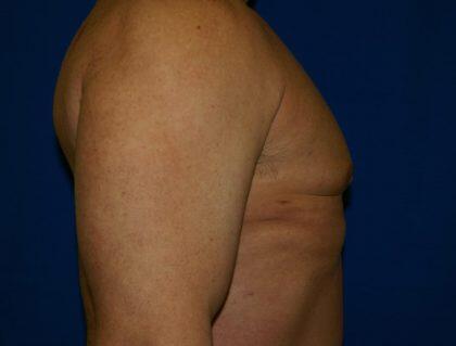 Gynecomastia Before & After Image