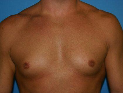 Gynecomastia Before & After Image