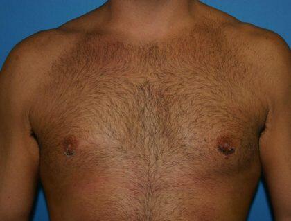 Gynecomastia Before & After Image