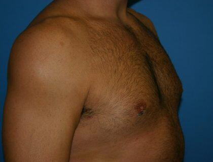 Gynecomastia Before & After Image