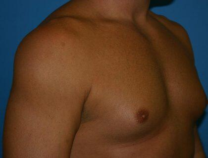 Gynecomastia Before & After Image