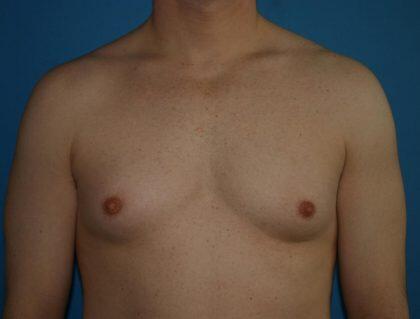 Gynecomastia Before & After Image