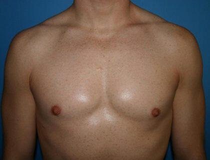 Gynecomastia Before & After Image