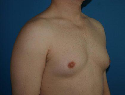 Gynecomastia Before & After Image