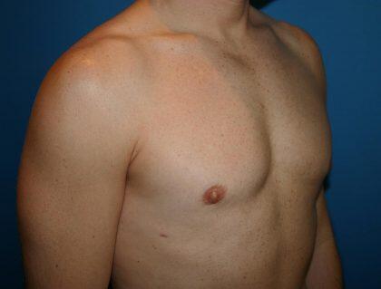 Gynecomastia Before & After Image