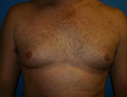 Gynecomastia Before & After Image