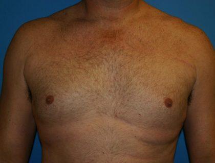 Gynecomastia Before & After Image