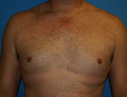 Gynecomastia Before & After Image