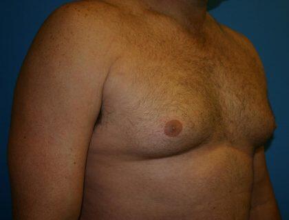 Gynecomastia Before & After Image