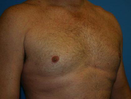 Gynecomastia Before & After Image