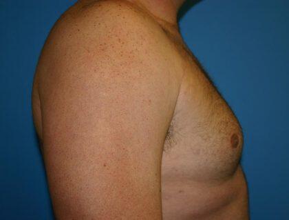 Gynecomastia Before & After Image