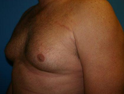 Gynecomastia Before & After Image
