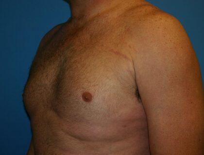 Gynecomastia Before & After Image
