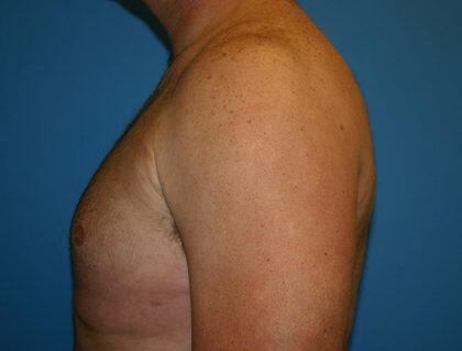 Gynecomastia Before & After Image