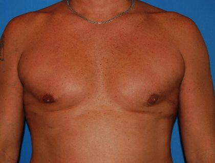 Gynecomastia Before & After Image