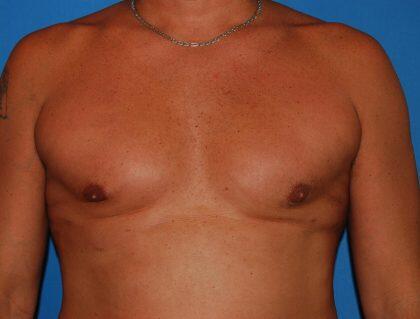 Gynecomastia Before & After Image