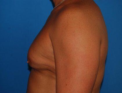 Gynecomastia Before & After Image