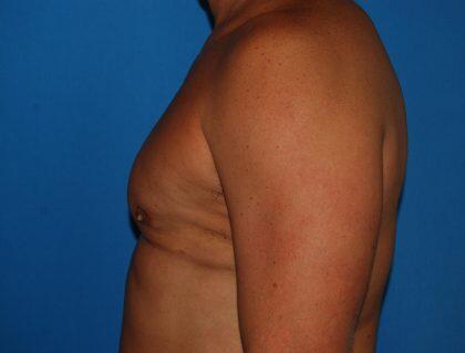 Gynecomastia Before & After Image