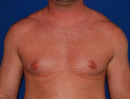 Gynecomastia Before & After Image