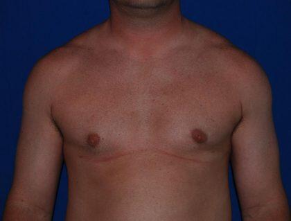 Gynecomastia Before & After Image