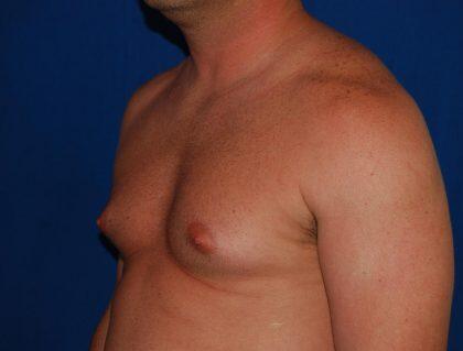 Gynecomastia Before & After Image