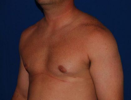 Gynecomastia Before & After Image