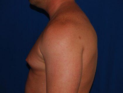 Gynecomastia Before & After Image