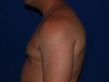 Gynecomastia Before & After Image