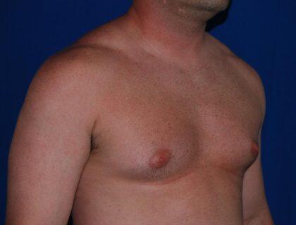 Gynecomastia Before & After Image