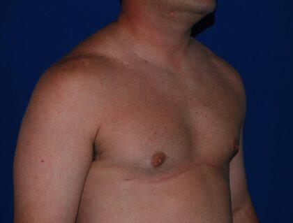 Gynecomastia Before & After Image