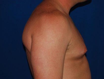 Gynecomastia Before & After Image