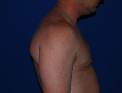 Gynecomastia Before & After Image