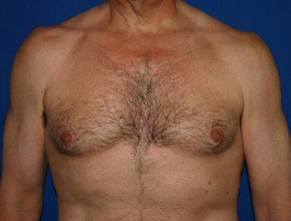 Gynecomastia Before & After Image