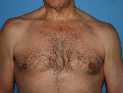 Gynecomastia Before & After Image