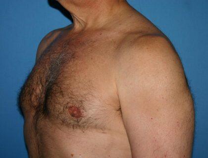 Gynecomastia Before & After Image