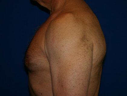 Gynecomastia Before & After Image