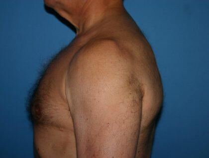 Gynecomastia Before & After Image