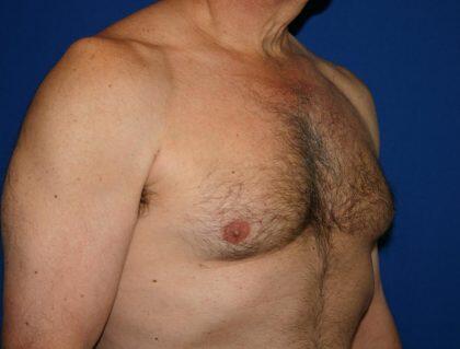 Gynecomastia Before & After Image