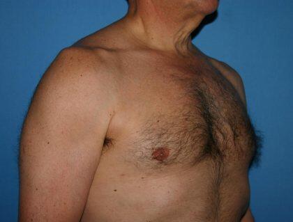 Gynecomastia Before & After Image