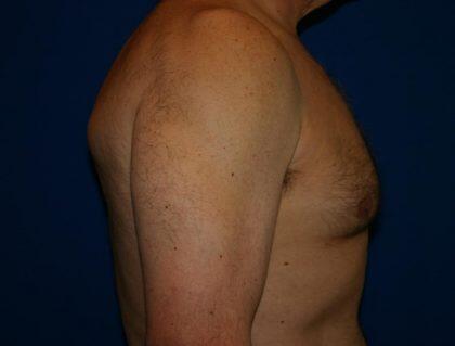 Gynecomastia Before & After Image