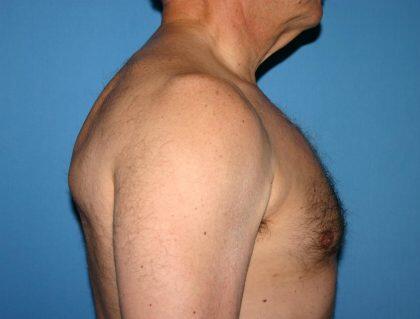 Gynecomastia Before & After Image