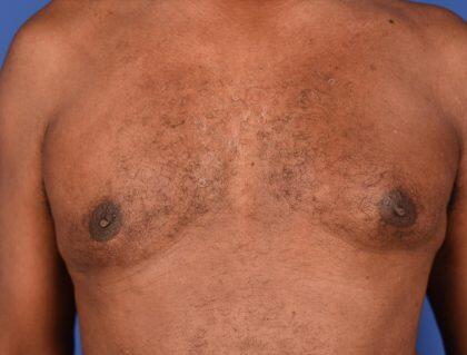 Gynecomastia Before & After Image