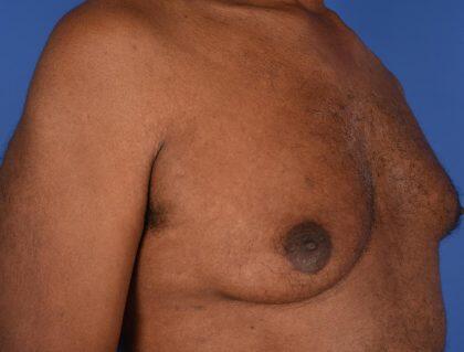 Gynecomastia Before & After Image