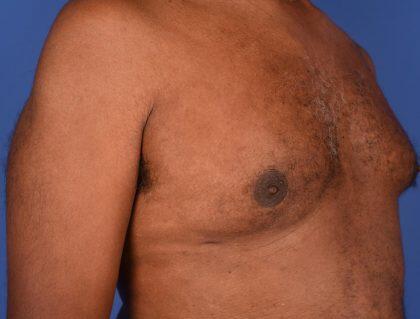 Gynecomastia Before & After Image