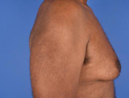 Gynecomastia Before & After Image