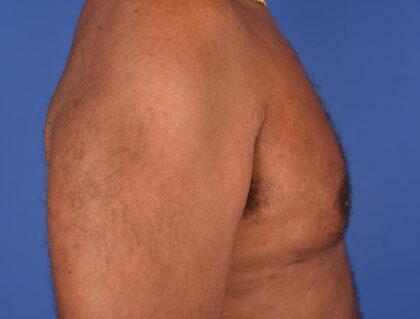 Gynecomastia Before & After Image