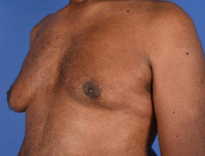 Gynecomastia Before & After Image